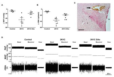 Renal Sensory Activity Regulates the γ-Aminobutyric Acidergic Inputs to the Paraventricular Nucleus of the Hypothalamus in Goldblatt Hypertension